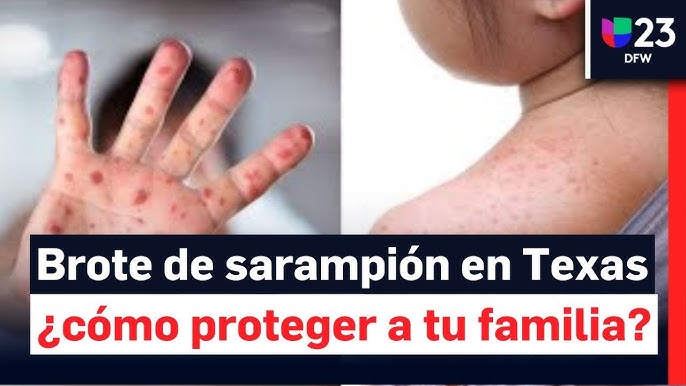 Texas en alerta roja  por nuevo brote de sarampión